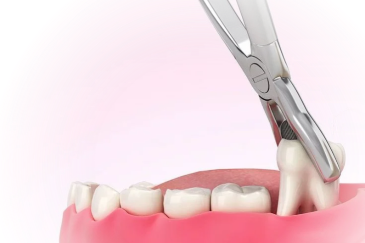 Phương pháp nhổ răng khôn truyền thống phù hợp với ca nhổ đơn giản