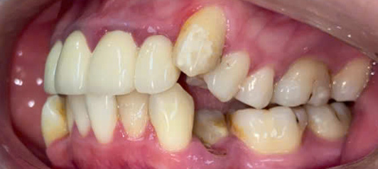 Mất răng khiến răng xô lệch nghiêm trọng