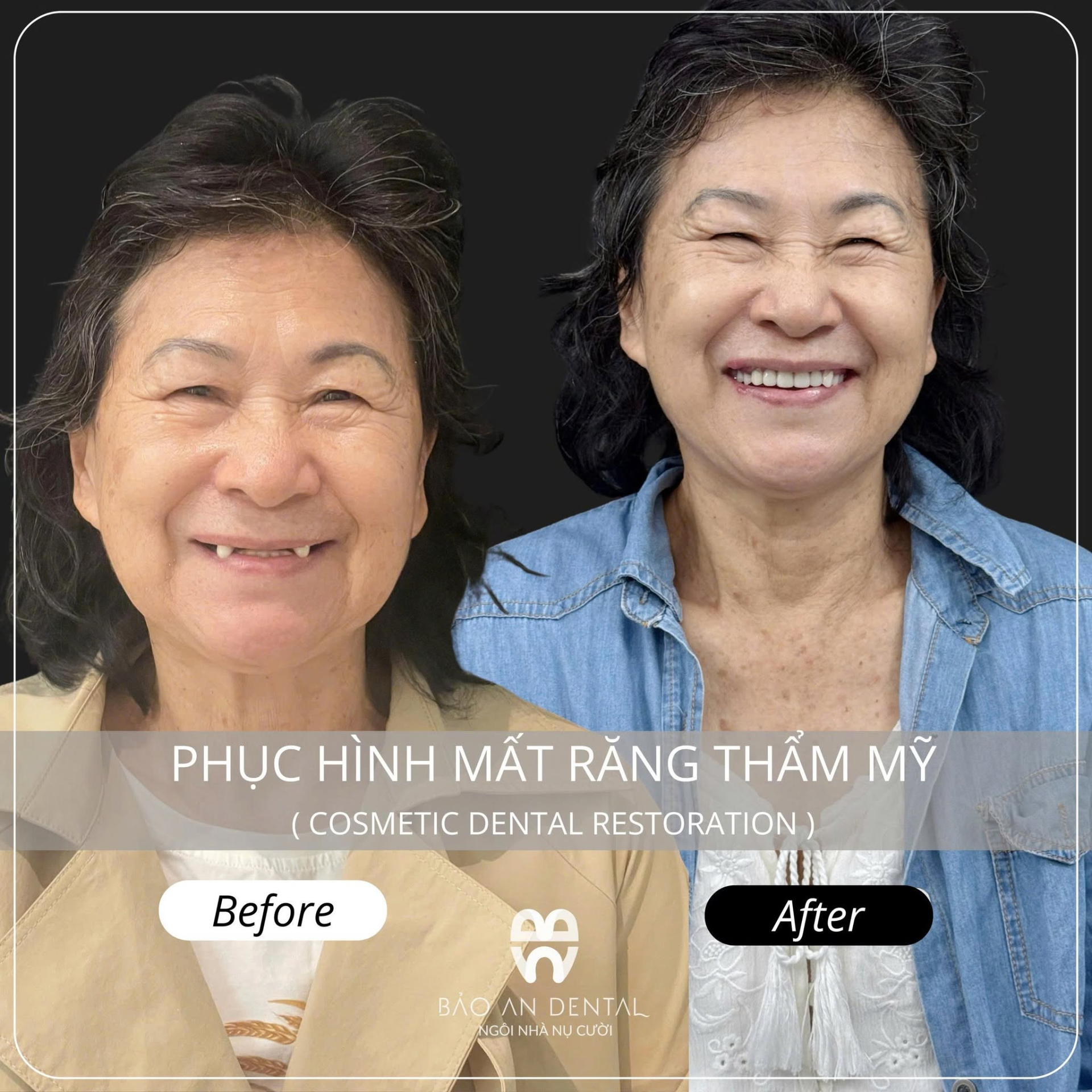 Implant Biotem Hàn Quốc – phục hồi răng mất, tự tin nụ cười