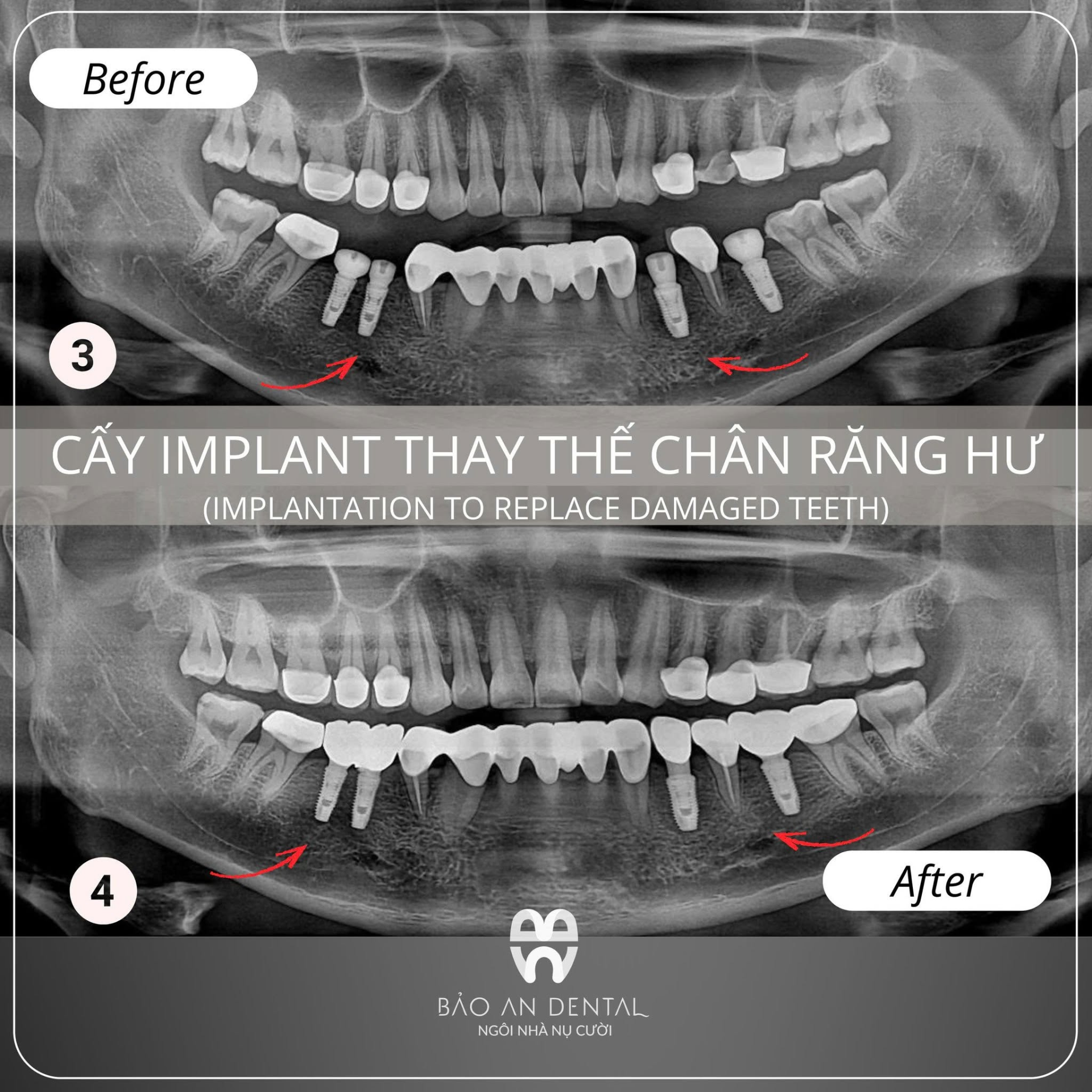 Trước và sau khi cấy Implant