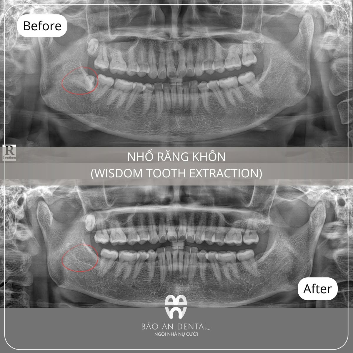 Răng khôn mọc ngang - Trước và sau nhổ răng khôn