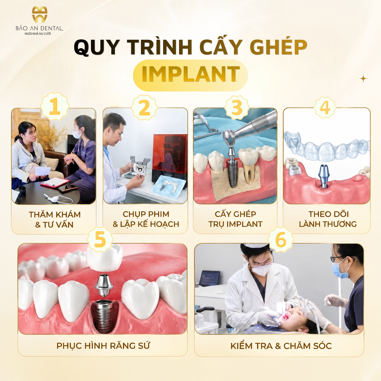 Quy trình cấy ghép Implant tại Bảo An Dental